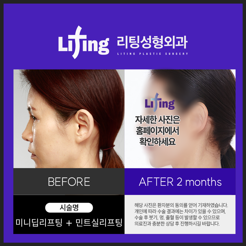 Facelift Plastic Surgery? Find It "This Way" and You Won't Fail image 6