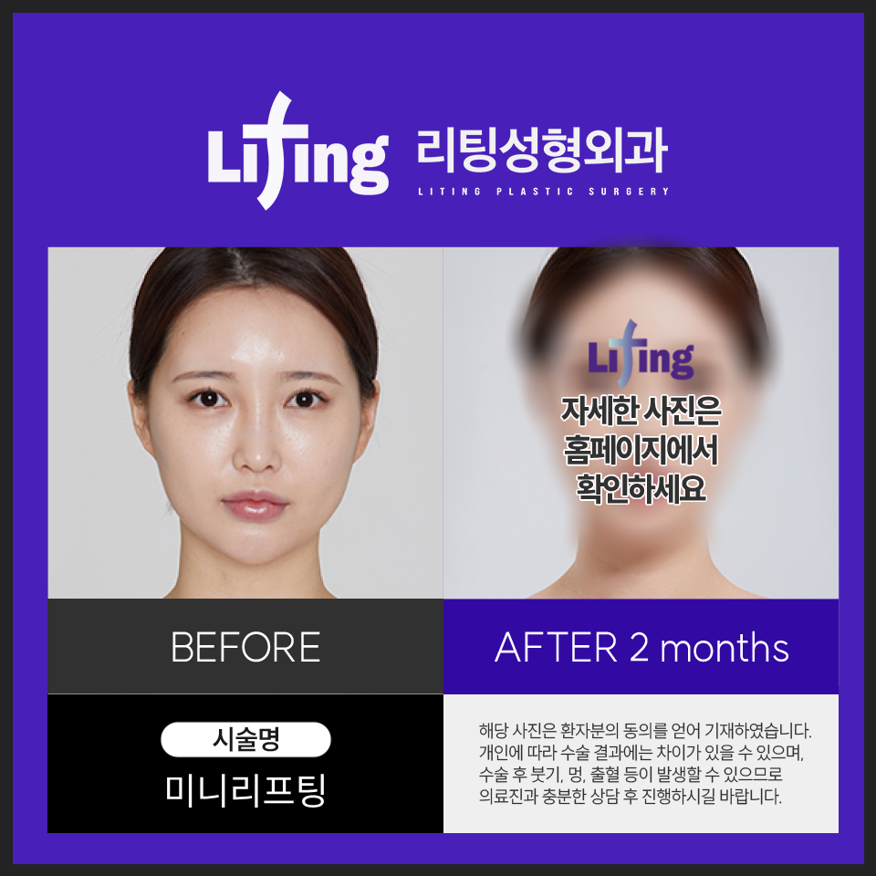 신논현성형외과 리프팅 성공하고 싶으면 2가지 기억하세요 관련 이미지 5
