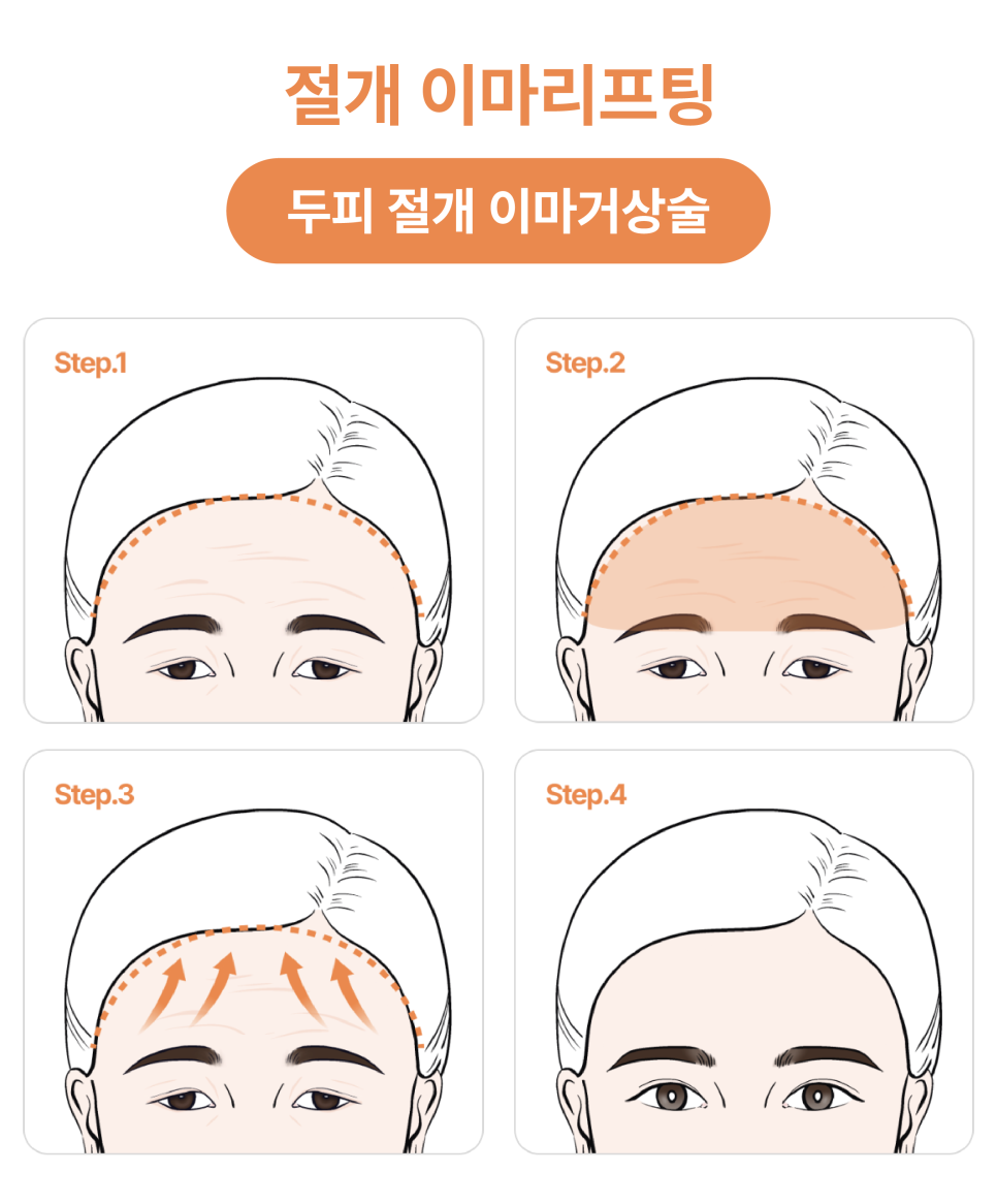 신사이마리프팅으로 달라지는 동안 한끗, 리프팅성형외과 전문의가 밝히는 결정적 차이 관련 이미지 12
