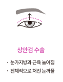 청담성형외과 눈꺼풀 처짐 고민, 안검하수비용이 궁금하다면? 관련 이미지 5