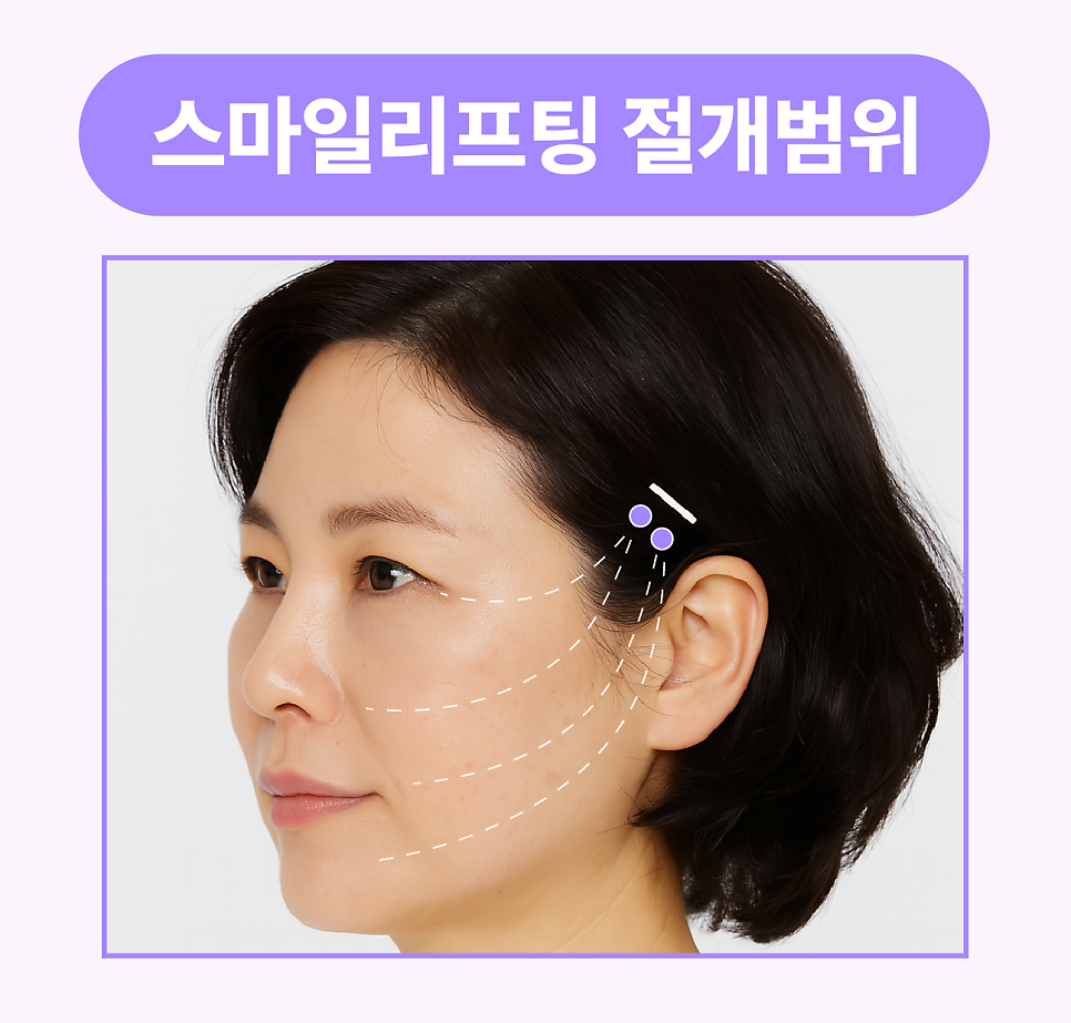 턱선리프팅 리팅미니리프팅 정보 (여름에 시너지나는 리프팅) 관련 이미지 8