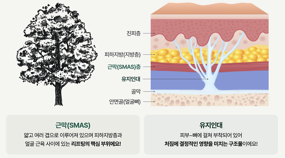 Seoul Liting Plastic Surgery Double Chin Removal: How Can a Blurry Jawline Be Restored? image 5