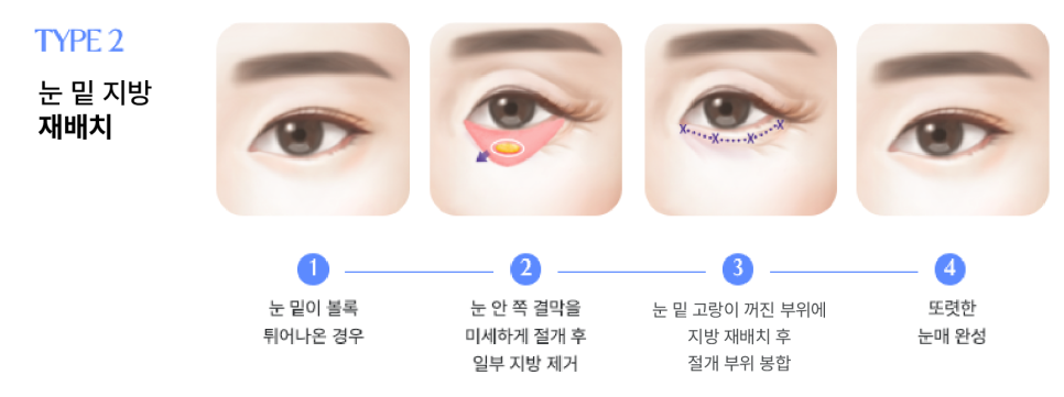 Sinsa Under-Eye Fat Repositioning: A Guide to Natural Under-Eye Changes from a Sinsa Lifting Dermatology Clinic image 10