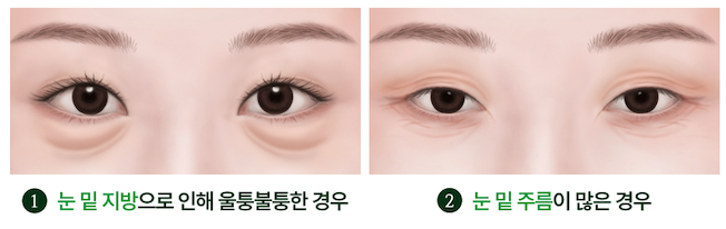 Sinsa Under-Eye Fat Repositioning: A Guide to Natural Under-Eye Changes from a Sinsa Lifting Dermatology Clinic image 4