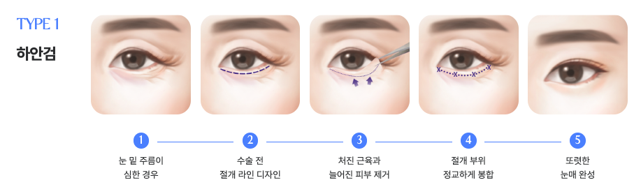 Sinsa Under-Eye Fat Repositioning: A Guide to Natural Under-Eye Changes from a Sinsa Lifting Dermatology Clinic image 9
