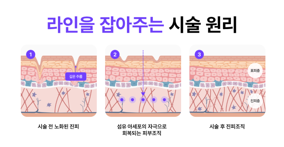 논현역성형외과 베네핏주사 수술 없이 피부 탄력 채우는 방법 관련 이미지 8