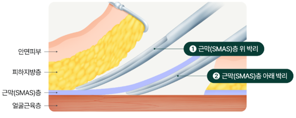 Facelift Gangnam Plastic Surgery Recommendation: Tips Shared by Leeting image 4