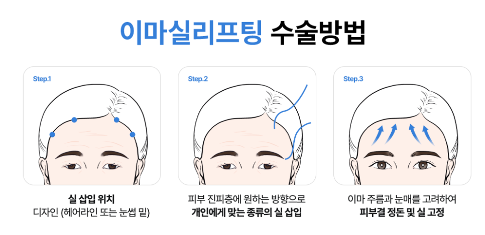 Why Forehead Thread Lifting and Drooping Eyelid Lifting Should Be Considered Together image 11