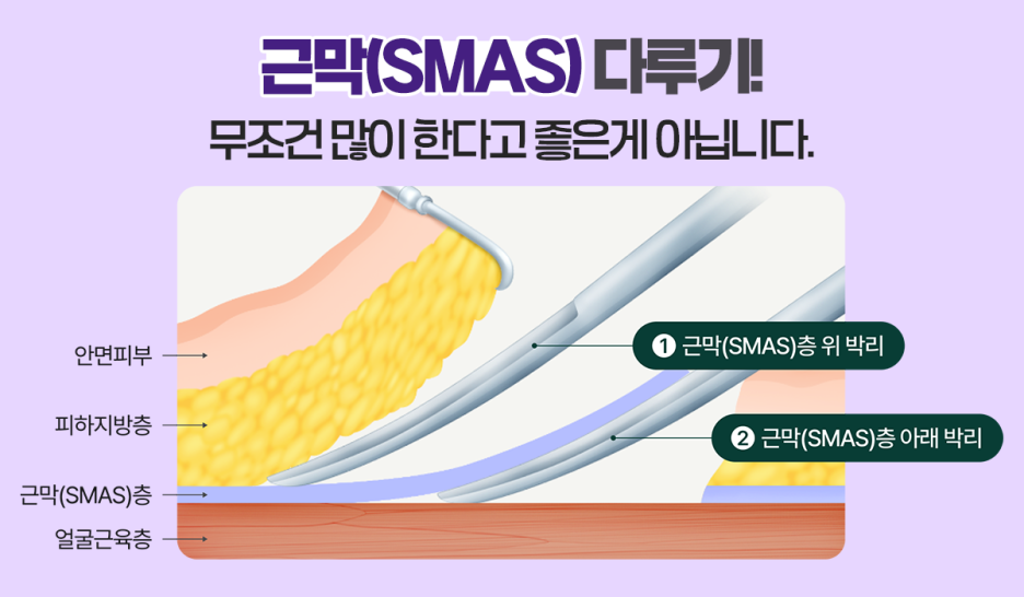 Facelift Surgery at Liting Plastic Surgery, a Medical Institution Focused on Lifting image 4