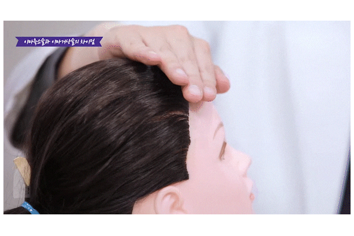 Songpa Plastic Surgery Forehead Wrinkle Botox: The Real Reason It Didn’t Work for Me image 15