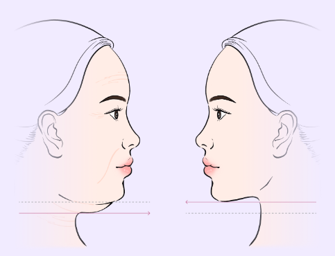 하안부는 왜 먼저 무너질까 청담미니리프팅과 브이라인리프팅의 구조적 접근 관련 이미지 13
