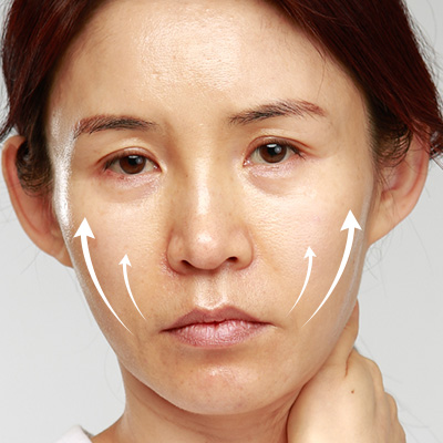 Considering a Facelift in Your 40s? Why Ligament Dissection Is Important at a Gangnam Lifting Clinic image 1