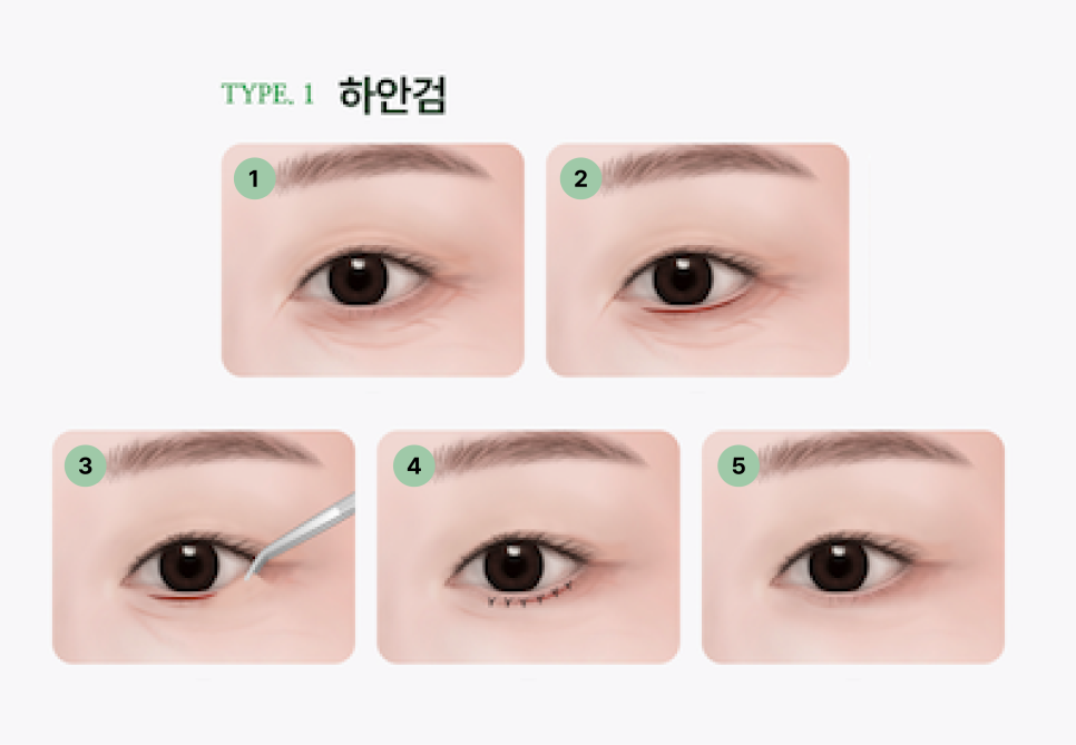 Understanding Gangnam Under-Eye Fat Repositioning, Causes of Hollow Under Eyes, and How the Structure Around the Eyes Changes with Age image 13