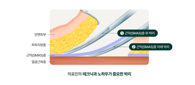 얼굴실리프팅 목주름보톡스, 목주름 솔루션 여름이 타이밍! 관련 이미지 13