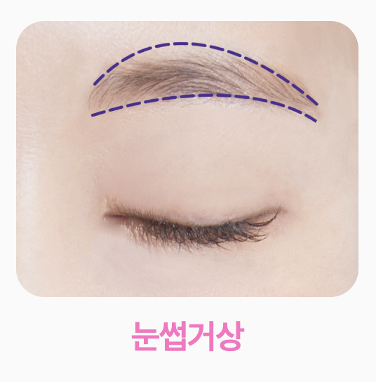Smiley Lift, How to Improve Midface Sagging While Reducing Incision 부담｜Sinsa Lifting Plastic Surgery Clinic image 12