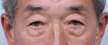 Understanding Gangnam Under-Eye Fat Repositioning, Causes of Hollow Under Eyes, and How the Structure Around the Eyes Changes with Age image 6