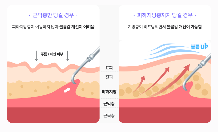 Mini Facelift, Gangnam Facelift: 3 Features That Create a Youthful Effect image 17