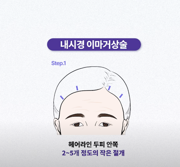 Songpa Plastic Surgery Forehead Wrinkle Botox: The Real Reason It Didn’t Work for Me image 10
