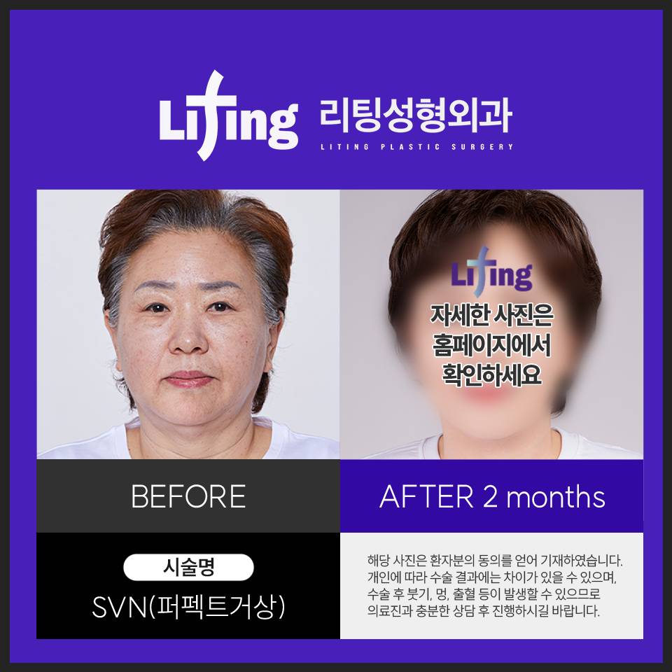 60대 안면거상후기 만족스러운 결과물을 얻기 위해서는? 관련 이미지 4