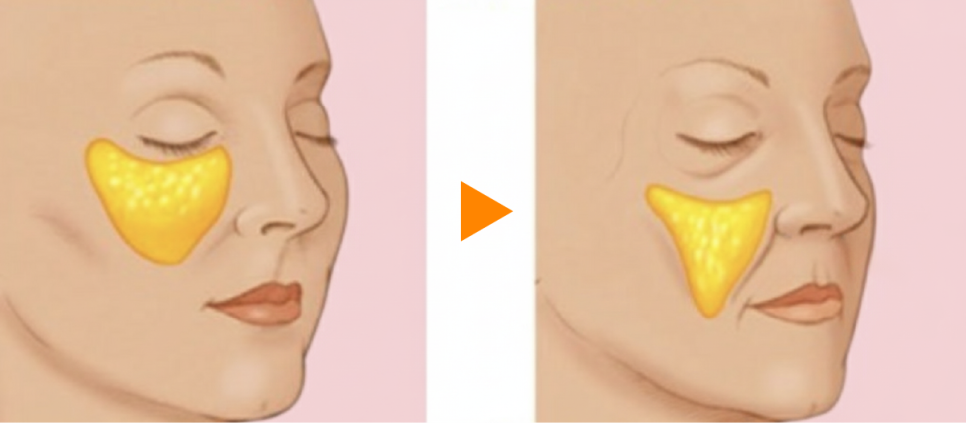 심부볼제거와 안면윤곽수술, 얼굴의 흐름을 디자인하는 리팅성형외과 서울점 또 다른 방법 관련 이미지 4