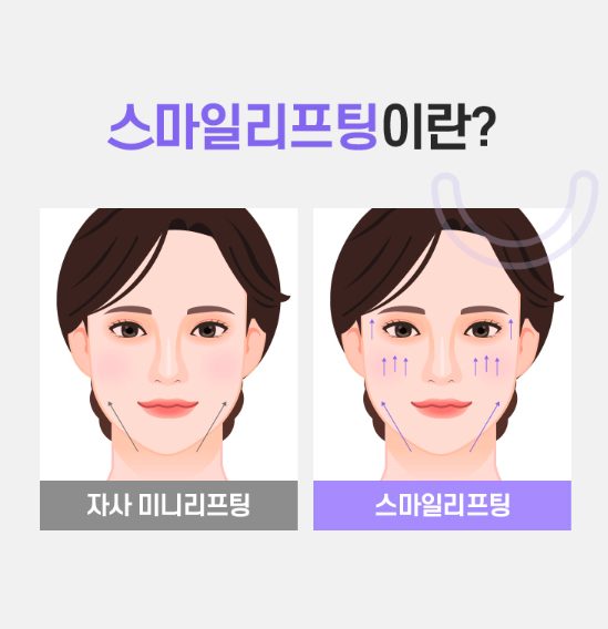 미니리프팅, 여름휴가 전 신사역성형외과에서 알아보는 인상 개선 방법 관련 이미지 9