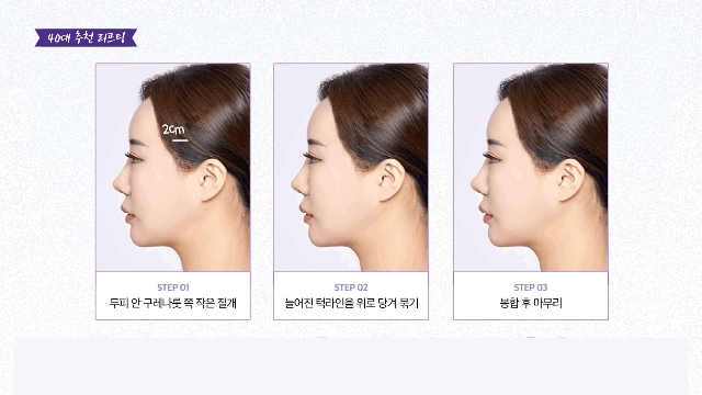 신사역성형외과 나이별로 가성비 좋은 리프팅, 실리프팅, 미니리프팅 관련 이미지 7