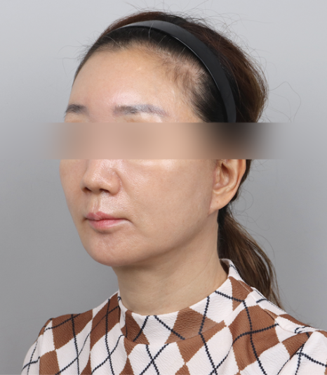 이중턱살없애는법? 리프팅 시술 10번 받아봤지만 효과 없었다면 이 글을 보세요 관련 이미지 7