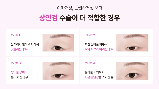 청담성형외과 눈꺼풀 처짐 고민, 안검하수비용이 궁금하다면? 관련 이미지 6