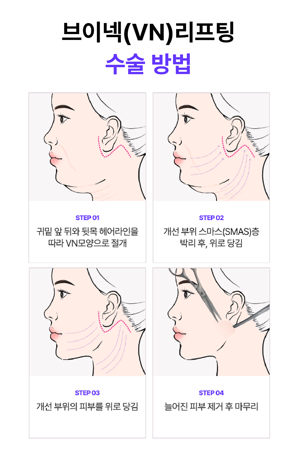 The Secret to Improving the Face and Neckline at the Same Time, Explained Through V-Neck Lifting and Recommended by a Sinsa Station Plastic Surgery Clinic image 10