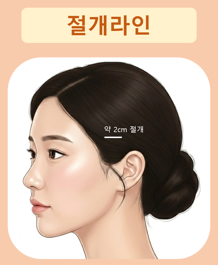 처진볼살리프팅후기에서 시작된 고민, 미니리프팅가격보다 중요한건 ‘방향’입니다 관련 이미지 7