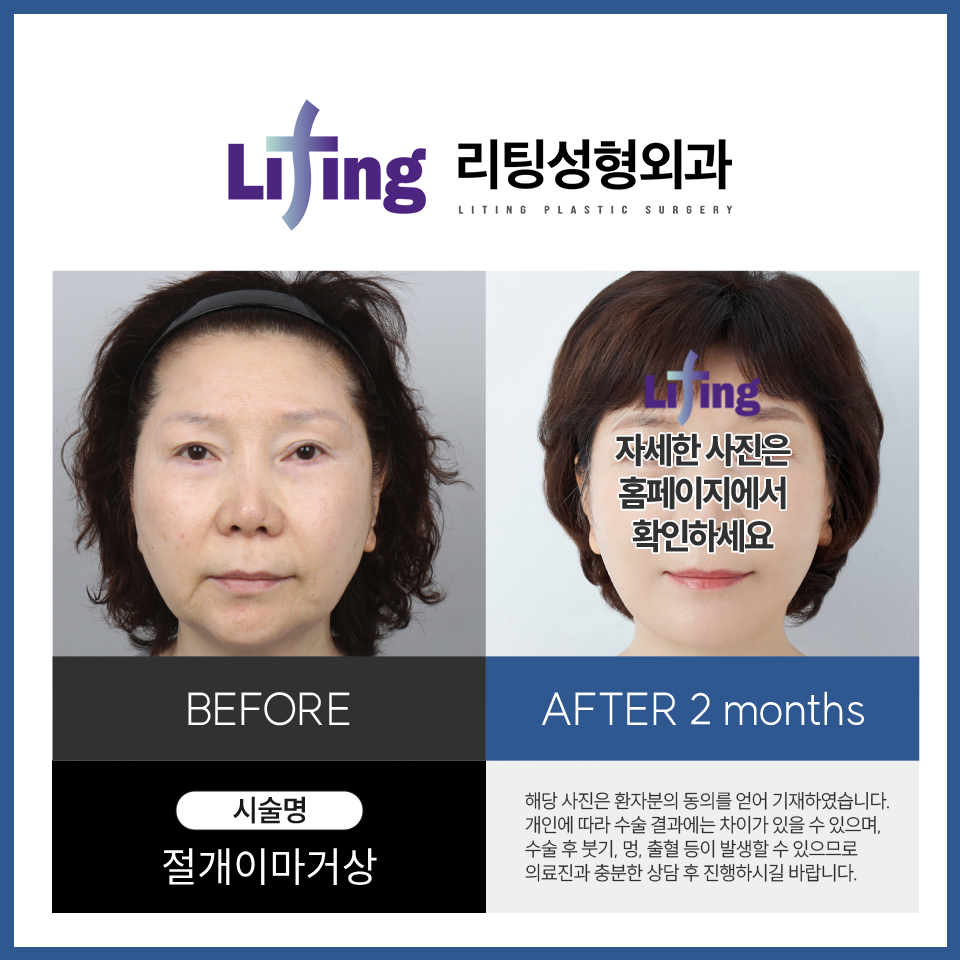 Forehead Lift Recovery Period? You Should Know Before Surgery image 9
