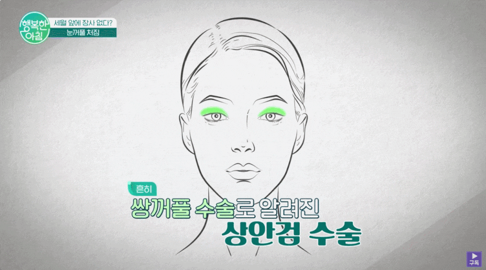 눈꺼풀처짐안검하수에 대한 오해와 진실 관련 이미지 3