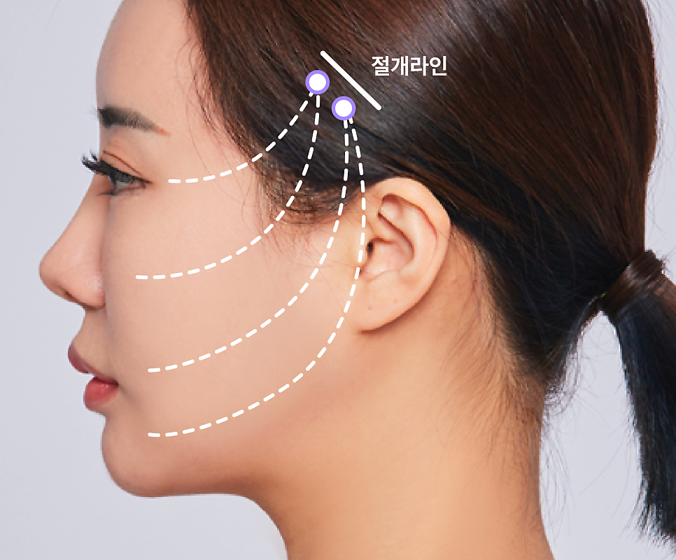 Smile Lifting Review and the Latest Lifting Trends Noted by Gangnam Lifting Dermatology Clinics image 10