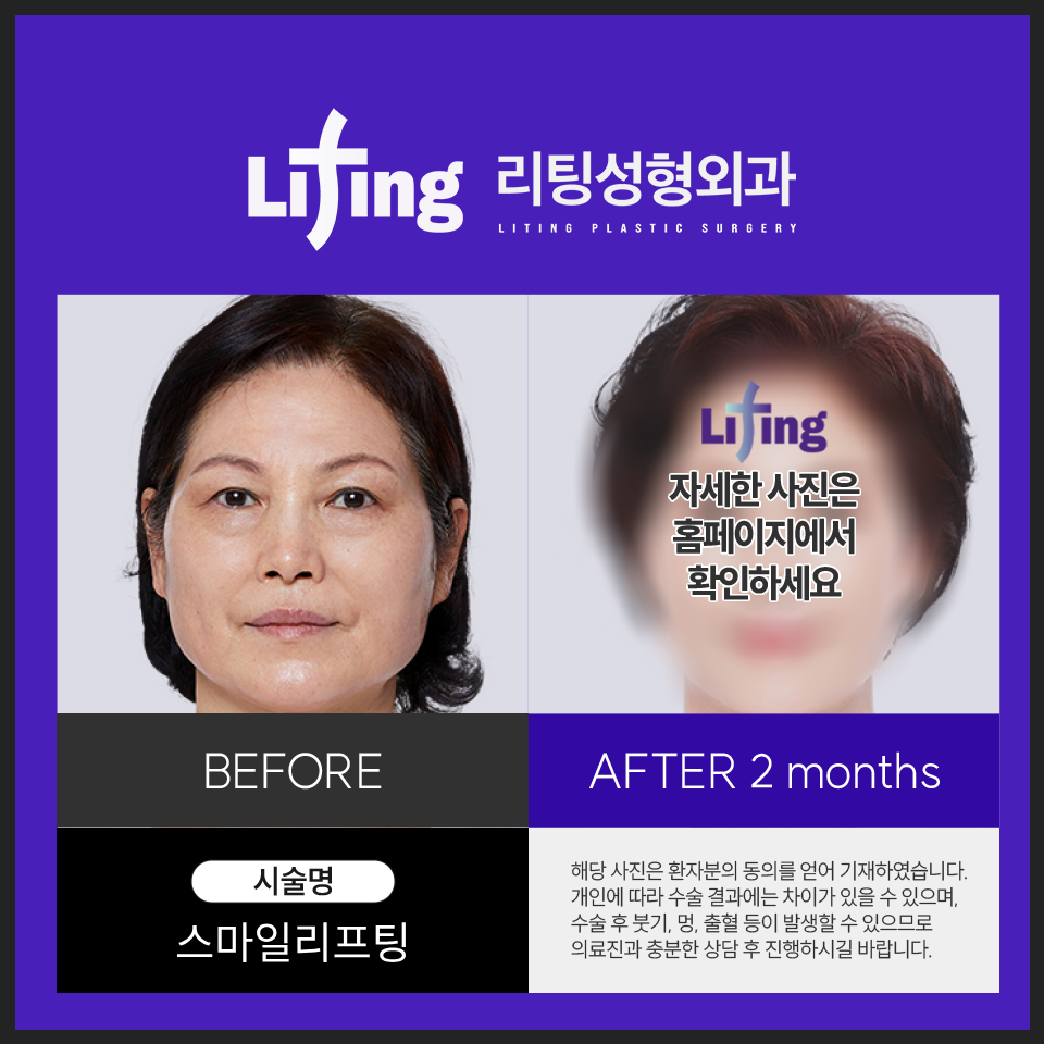 Facelift Plastic Surgery? Find It "This Way" and You Won't Fail image 5