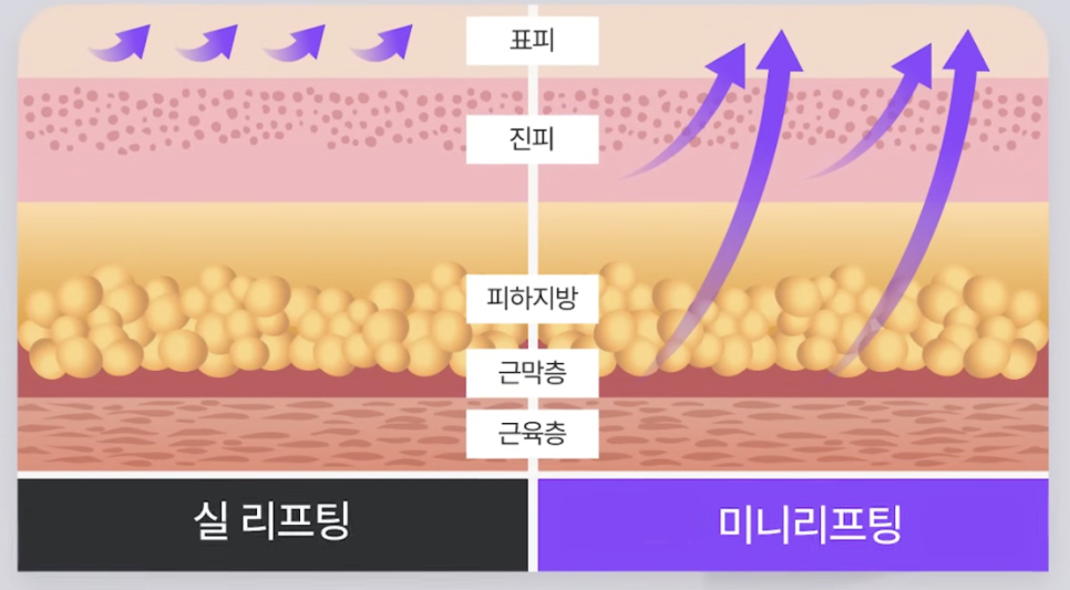 미니리프팅가격, 강남안면거상성형외과에서 보는 겨울 전 탄력 관리의 정밀 설계 관련 이미지 8