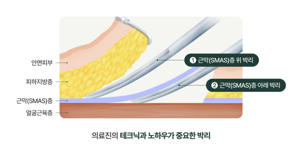 신사역리팅 안면거상술가격 차이, 비용보다 매우 중요한 건 ‘이것?’ 관련 이미지 11