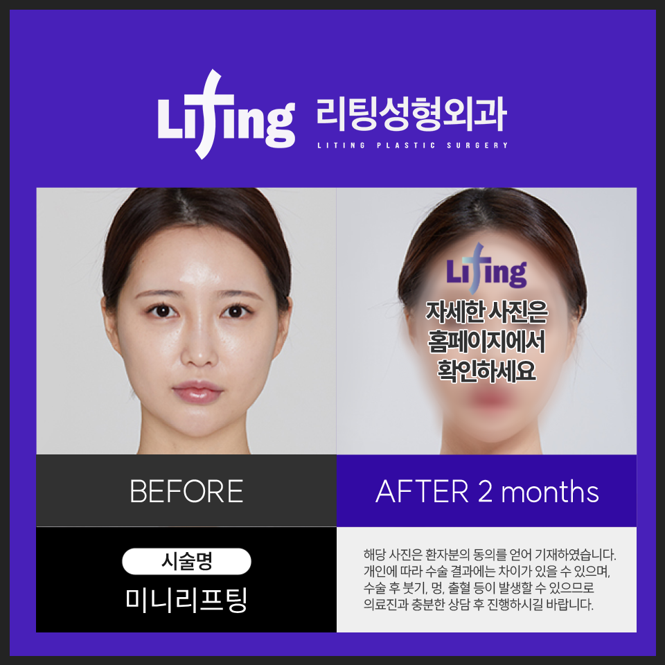 `리팅성형외과가 말하는 미니리프팅 핵심은 관련 이미지 8