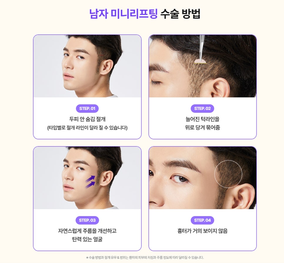 Male Facelift: Which Lifting Method Is Right? image 6