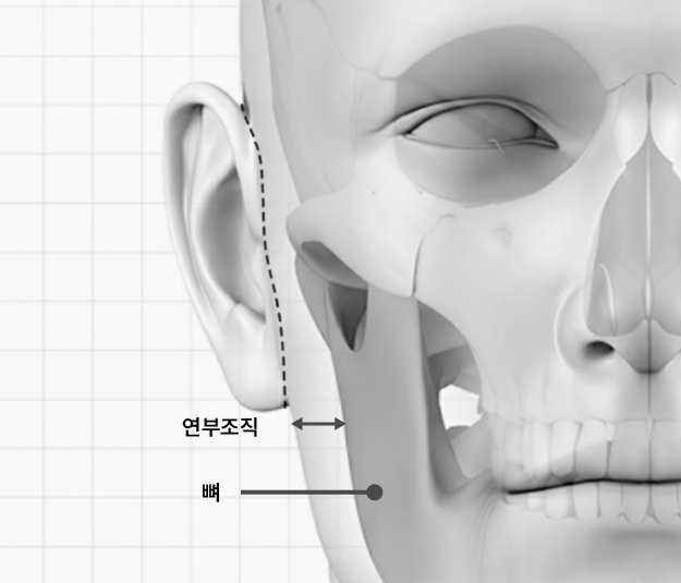 심부볼제거와 안면윤곽수술, 얼굴의 흐름을 디자인하는 리팅성형외과 서울점 또 다른 방법 관련 이미지 3