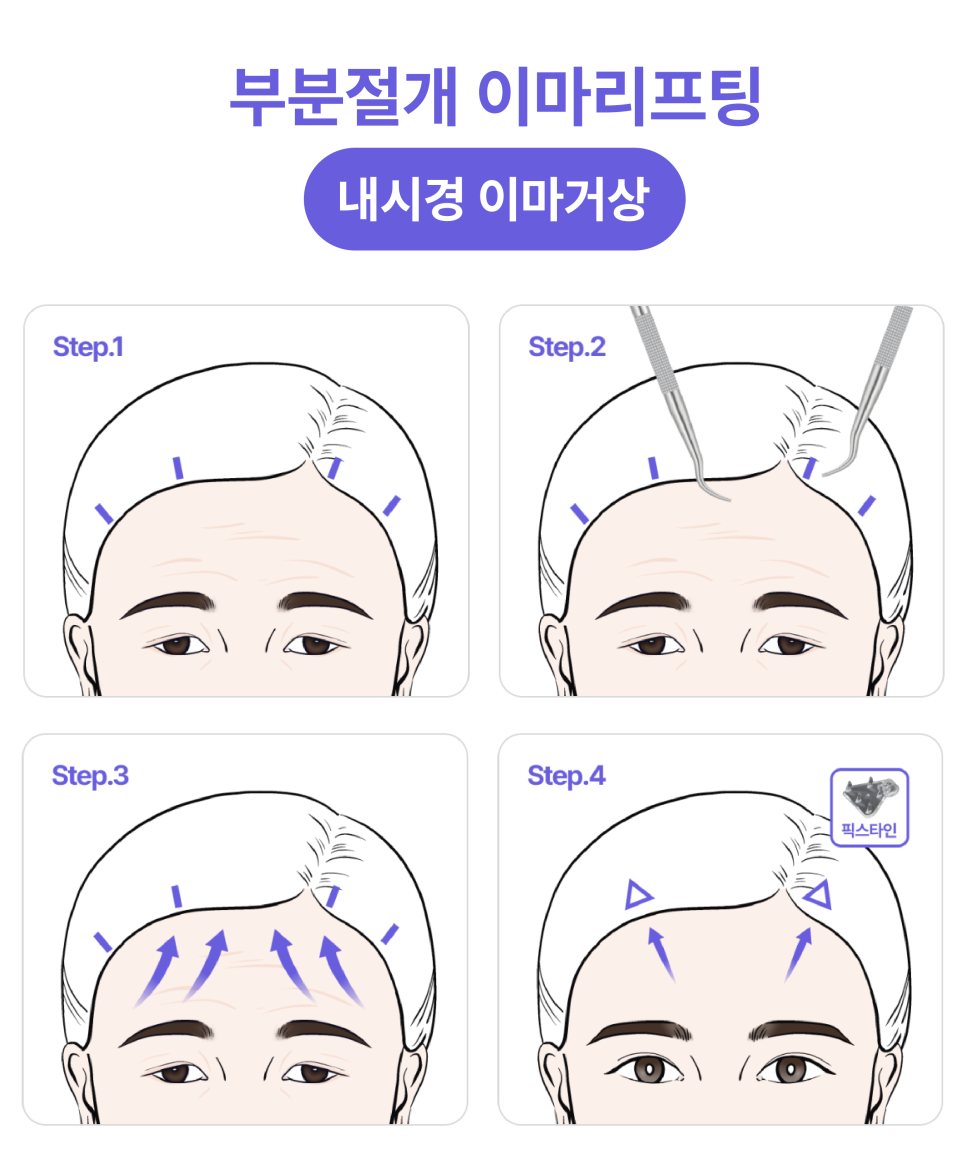 신사이마리프팅으로 달라지는 동안 한끗, 리프팅성형외과 전문의가 밝히는 결정적 차이 관련 이미지 11