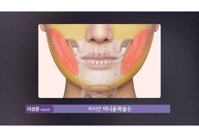 안면윤곽수술 뼈를 깎지 않고 윤곽선을 다듬는 신사윤곽성형외과 관련 이미지 7