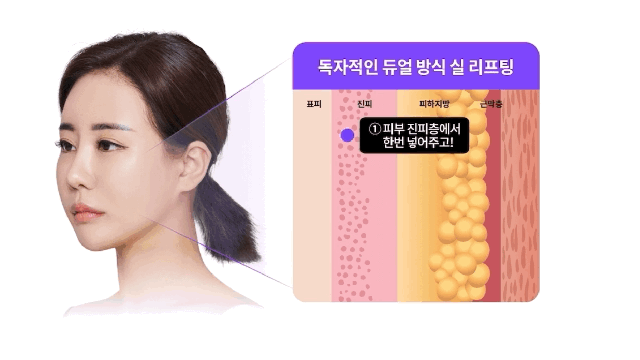 신사역성형외과 나이별로 가성비 좋은 리프팅, 실리프팅, 미니리프팅 관련 이미지 6