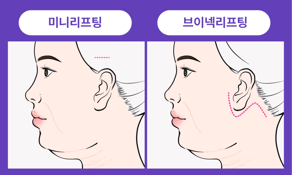 하안부는 왜 먼저 무너질까 청담미니리프팅과 브이라인리프팅의 구조적 접근 관련 이미지 15