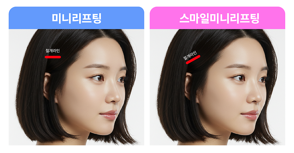 스마일미니리프팅, 압구정리프팅성형외과가 알려주는 인기많은 리프팅 최신 트렌드 관련 이미지 11