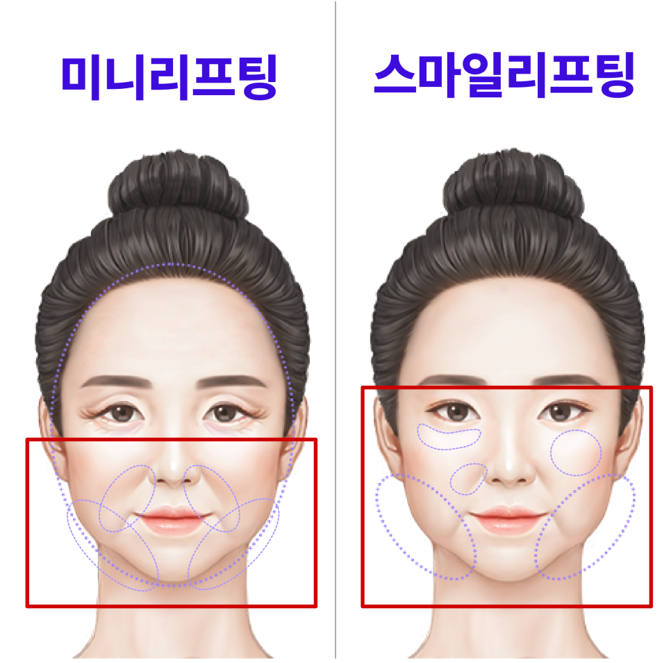 Shinsa Mini Lift, Lifting Plastic Surgery Clinic: Clear Answers to Frequently Asked Questions About Smile Lifting! image 8