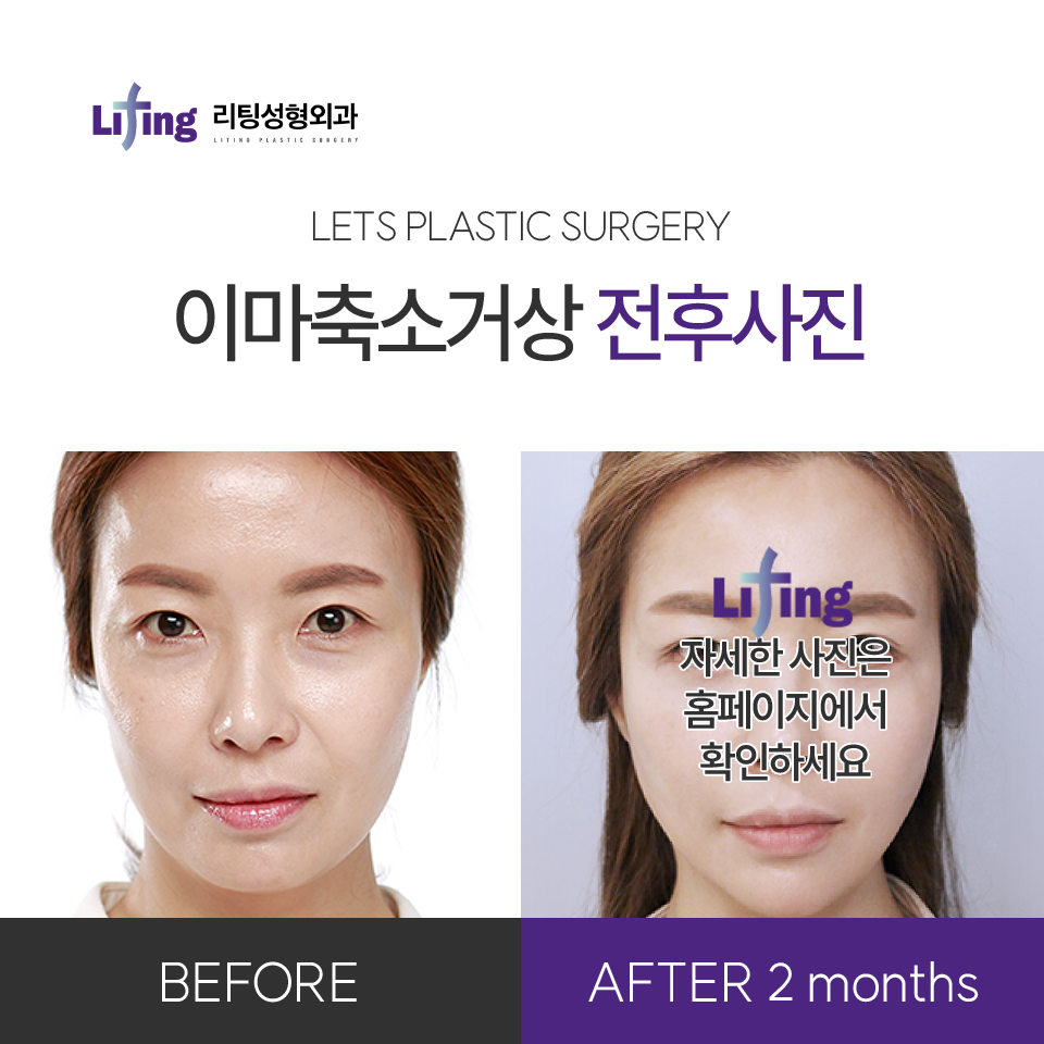 심부볼실리프팅, 효과 제대로 보고 싶다면 10분만 투자하세요 관련 이미지 9