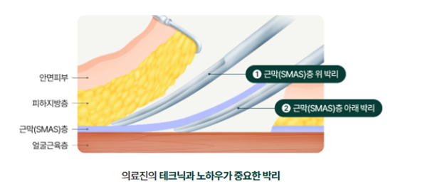 Facelift Surgery Price at a Lifting Plastic Surgery Clinic: Why Does It Vary So Much Depending on This? image 5