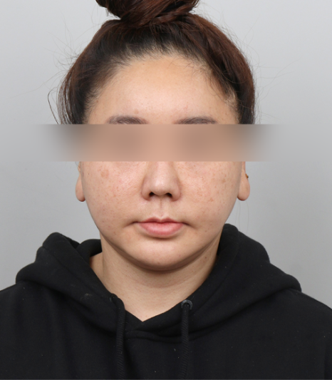 이중턱살없애는법? 리프팅 시술 10번 받아봤지만 효과 없었다면 이 글을 보세요 관련 이미지 4