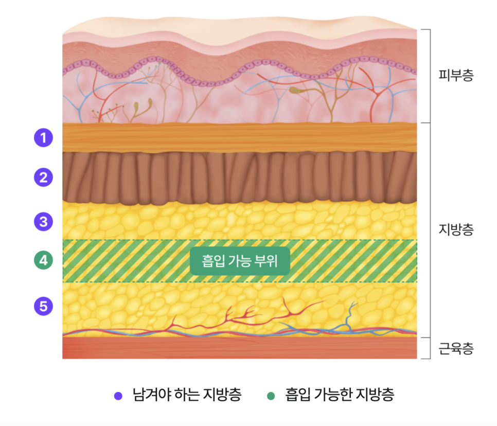 심부볼제거와 안면윤곽수술, 얼굴의 흐름을 디자인하는 리팅성형외과 서울점 또 다른 방법 관련 이미지 12
