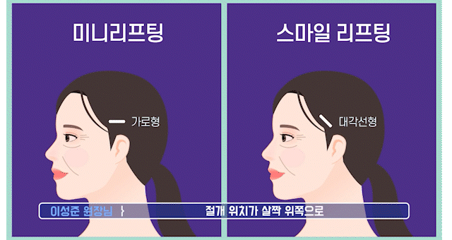 처진볼살리프팅후기에서 시작된 고민, 미니리프팅가격보다 중요한건 ‘방향’입니다 관련 이미지 12